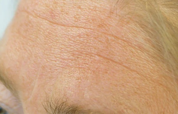 Microneedling behandeling bij SKIN MISSON in Eindhoven.