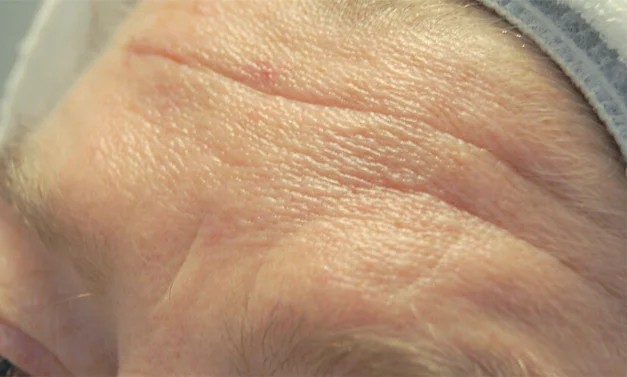 Microneedling behandeling bij SKIN MISSON in Eindhoven.