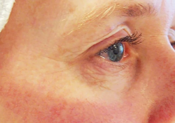 Microneedling behandeling bij SKIN MISSON in Eindhoven.