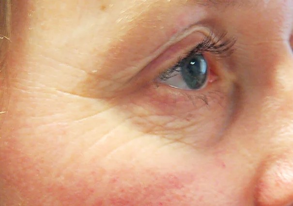 Microneedling behandeling bij SKIN MISSON in Eindhoven.