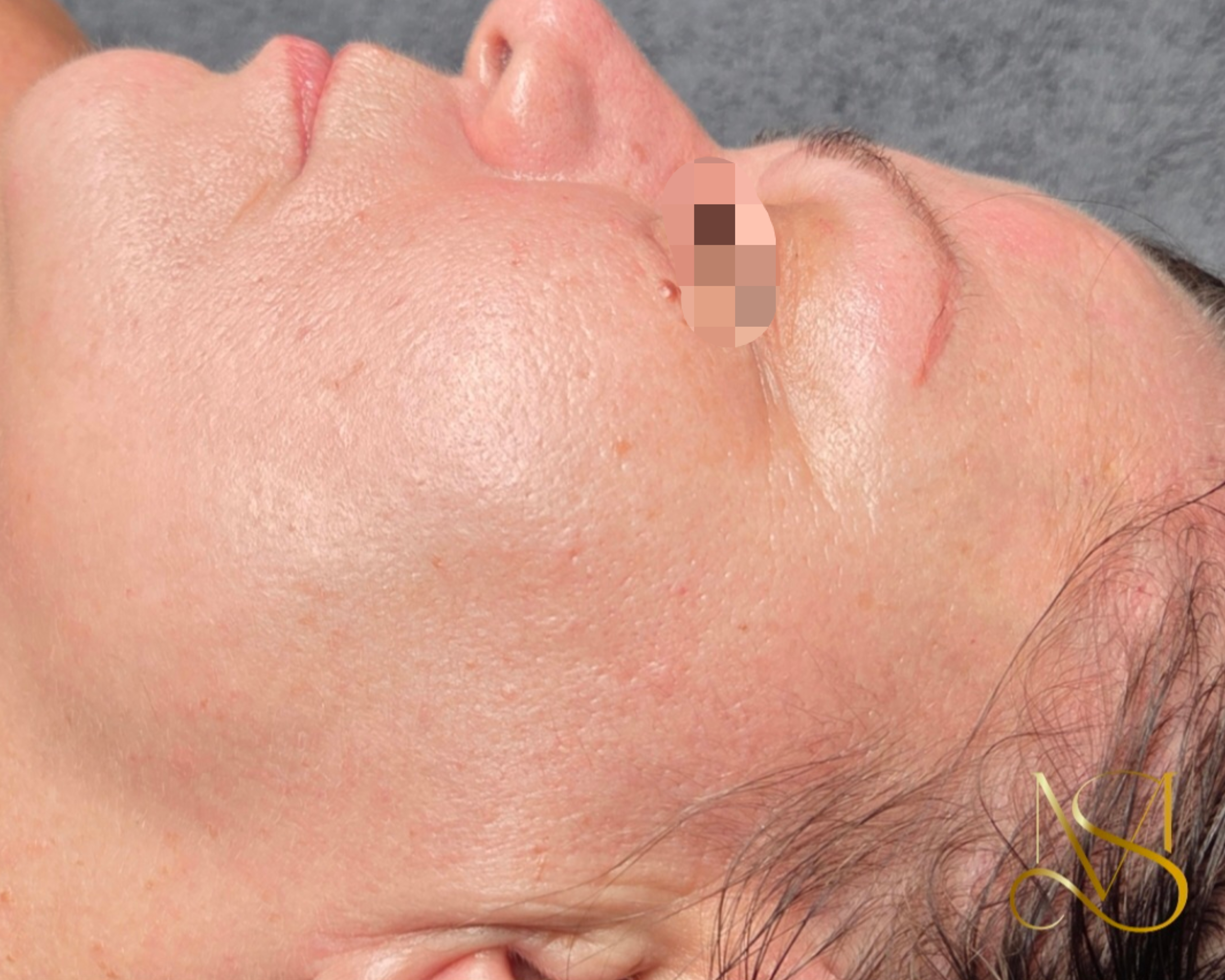 Microneedling behandeling bij SKIN MISSON in Eindhoven.