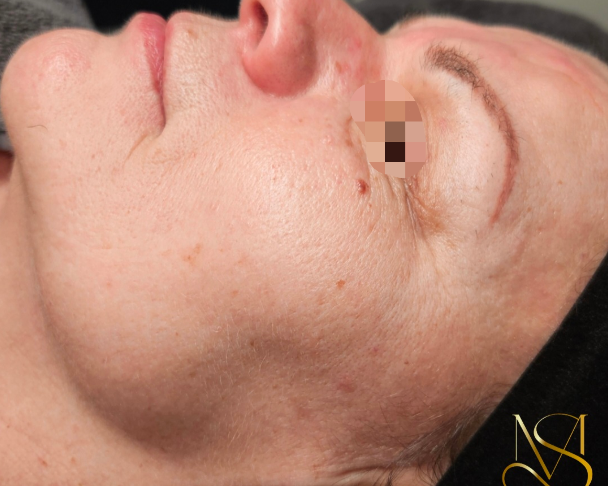 Microneedling behandeling bij SKIN MISSON in Eindhoven.
