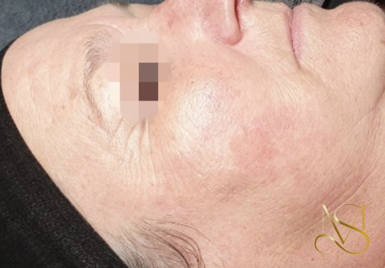 Pigment reset behandeling bij SKIN MISSON in Eindhoven.