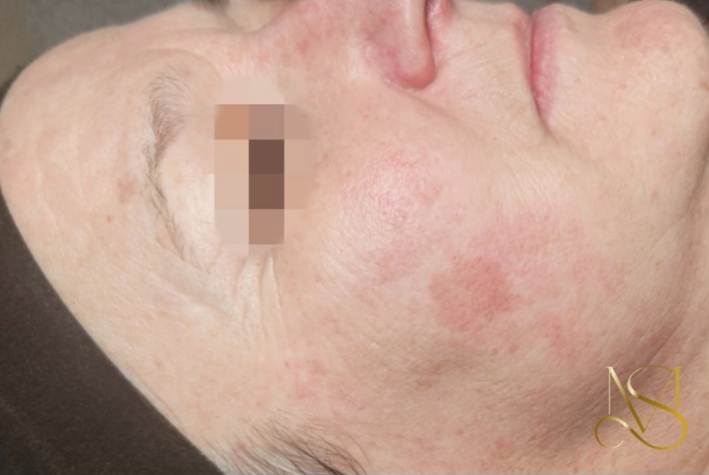 Pigment reset behandeling bij SKIN MISSON in Eindhoven.