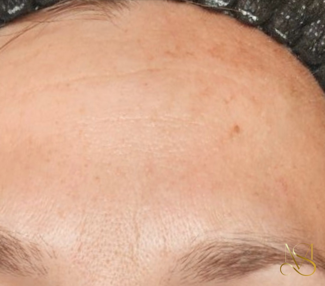 Signature Glow behandeling bij SKIN MISSON in Eindhoven.