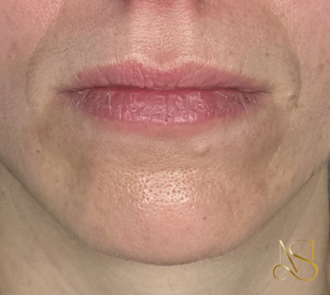 Signature Glow behandeling bij SKIN MISSON in Eindhoven.