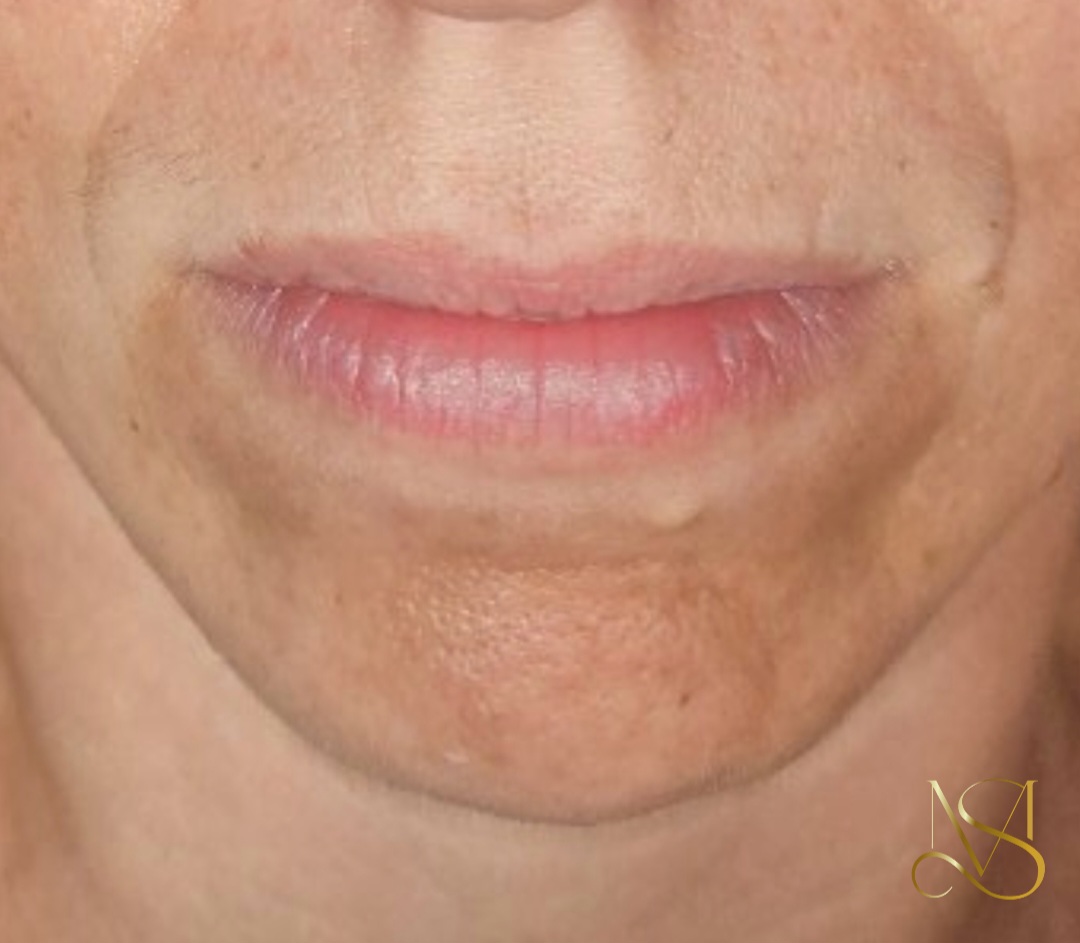 Signature Glow behandeling bij SKIN MISSON in Eindhoven.