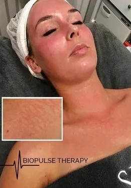 Bio Pulse behandeling bij SKIN MISSION in Eindhoven.