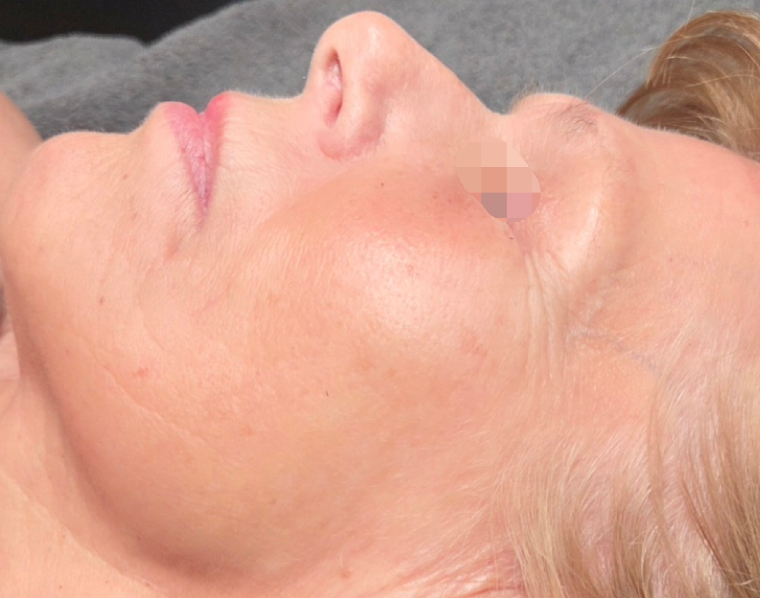 Natural face lift behandeling bij SKIN MISSION in Eindhoven