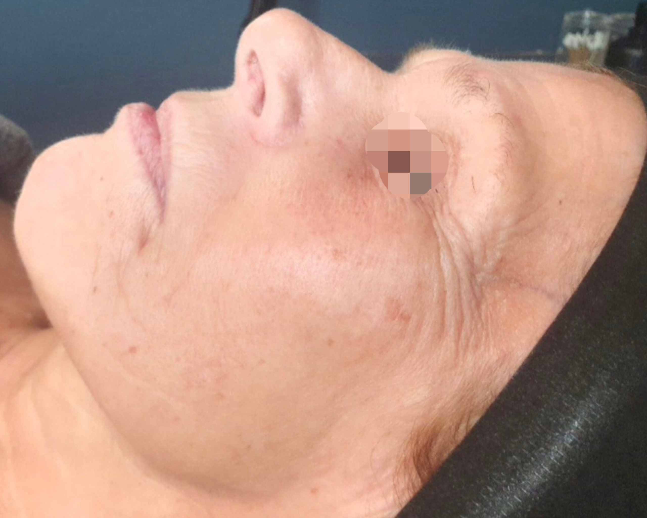 Natural face lift behandeling bij SKIN MISSION in Eindhoven