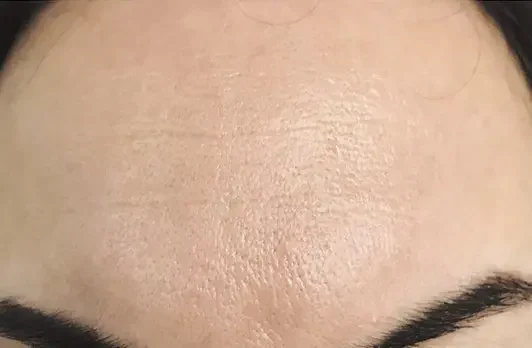 Bio Peel bij SKIN MISSION in Eindhoven