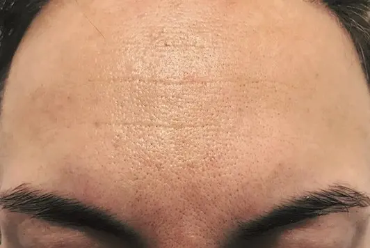 Bio Peel bij SKIN MISSION in Eindhoven