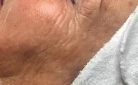 Bio Pulse behandeling bij SKIN MISSON in Eindhoven.