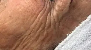 Bio Pulse behandeling bij SKIN MISSON in Eindhoven.