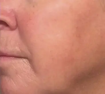 Fruitzuur behandeling bij SKIN MISSON in Eindhoven.