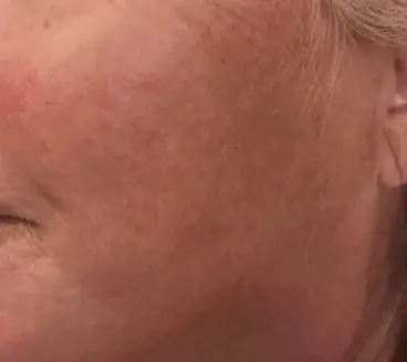 Fruitzuur behandeling bij SKIN MISSON in Eindhoven.