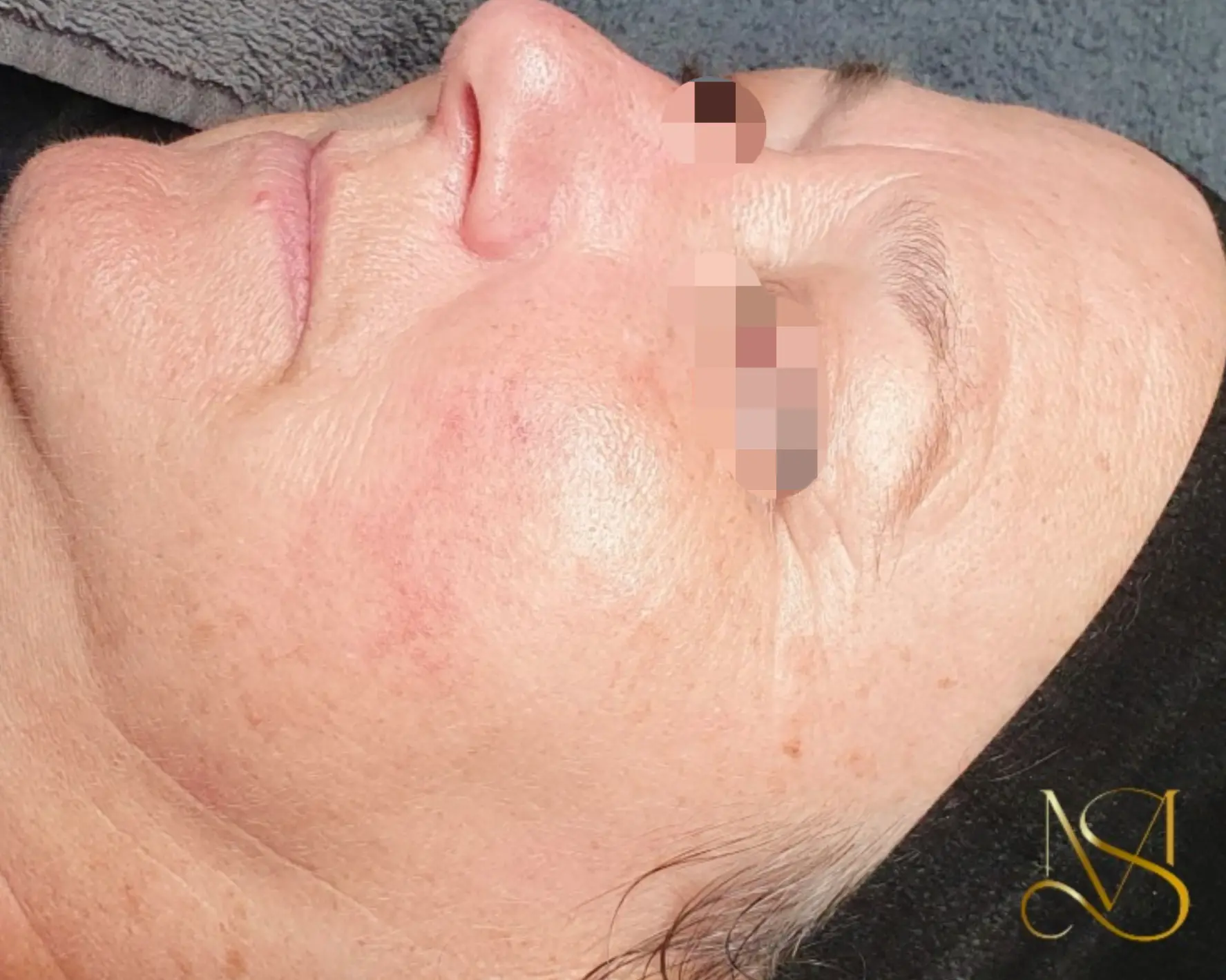 Microneedling behandeling bij SKIN MISSON in Eindhoven.