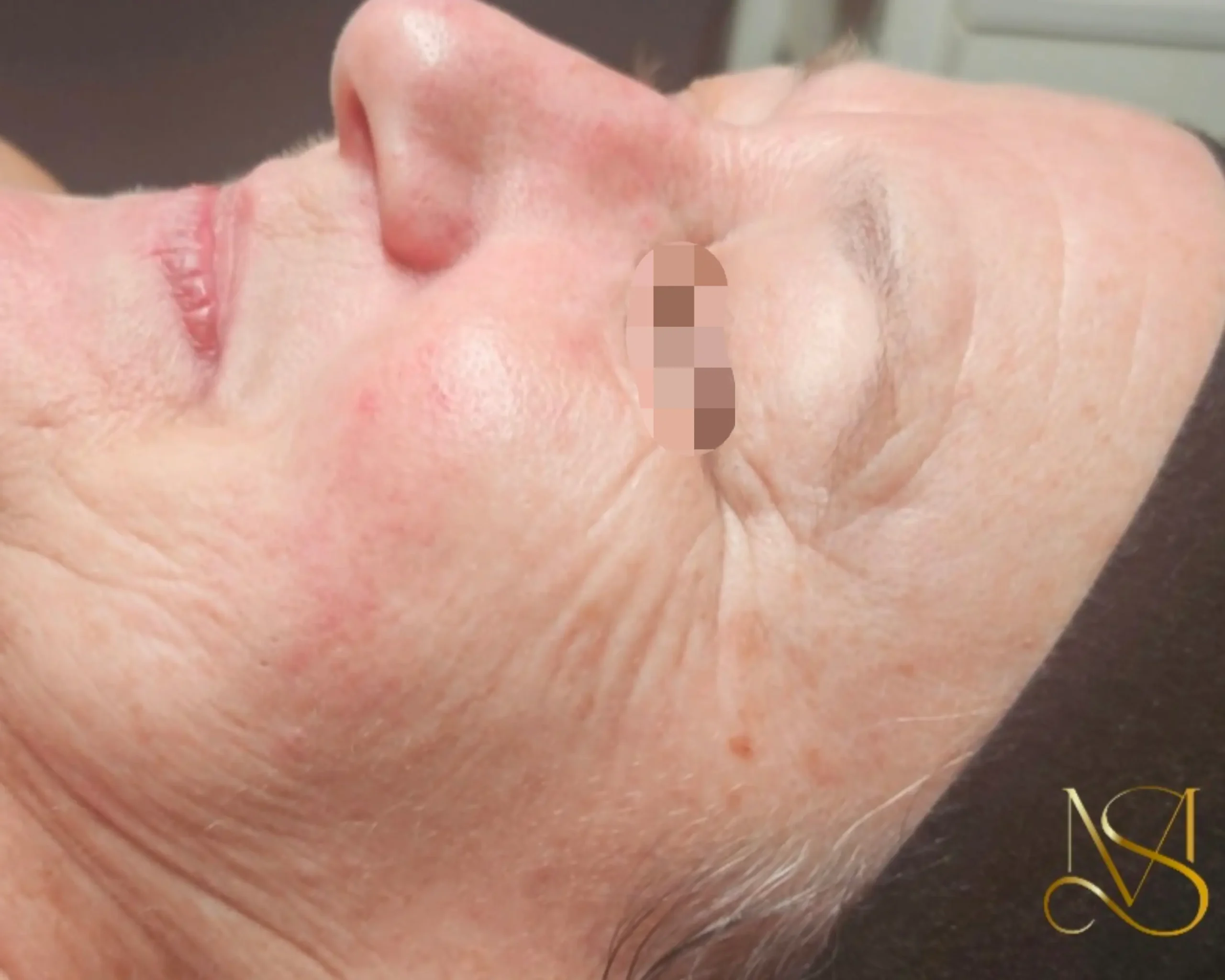 Microneedling behandeling bij SKIN MISSON in Eindhoven.