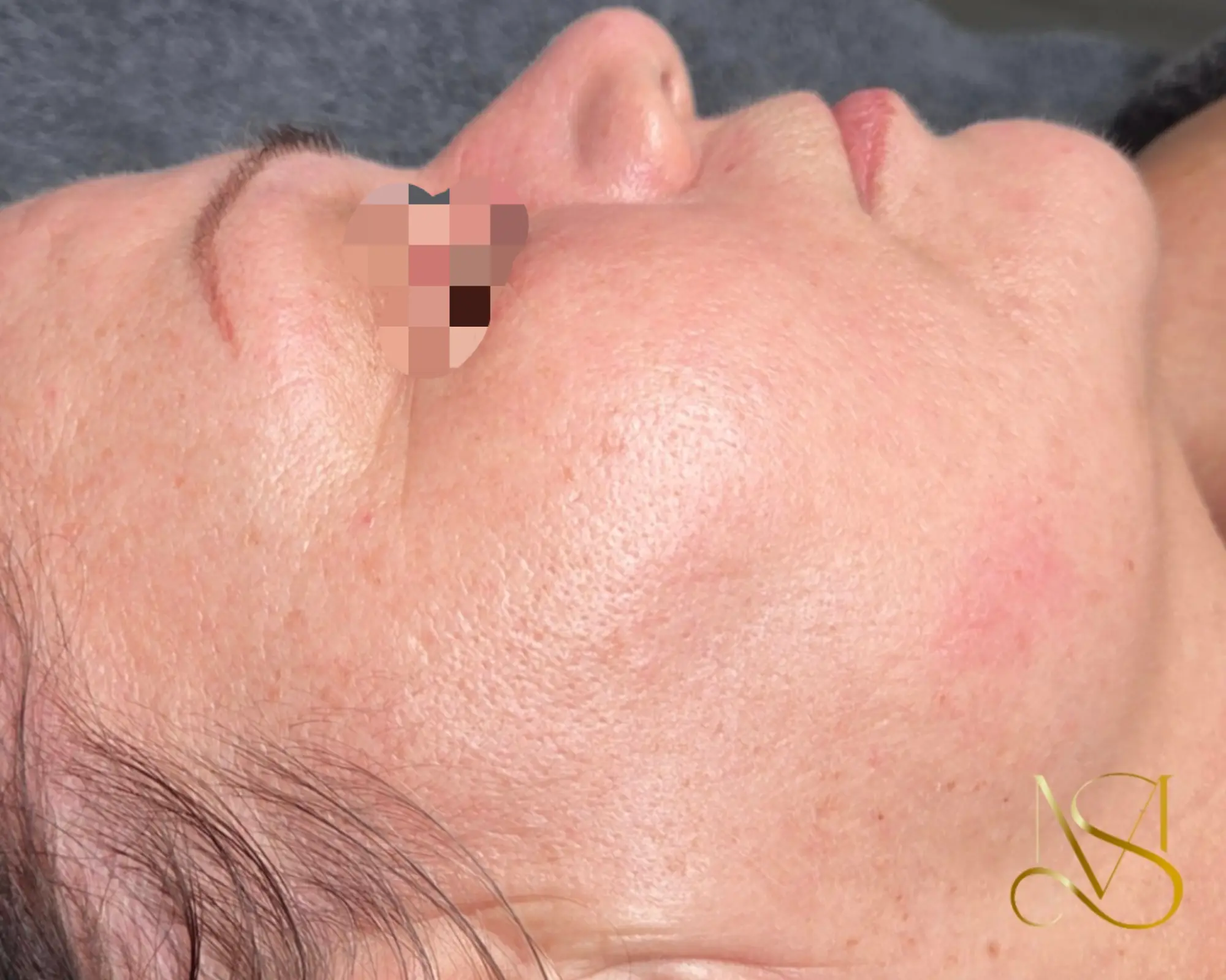 Microneedling behandeling bij SKIN MISSON in Eindhoven.
