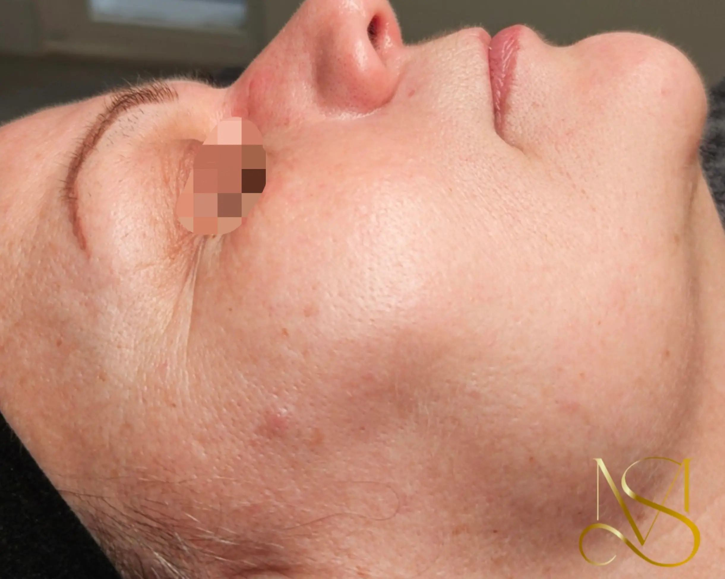 Microneedling behandeling bij SKIN MISSON in Eindhoven.