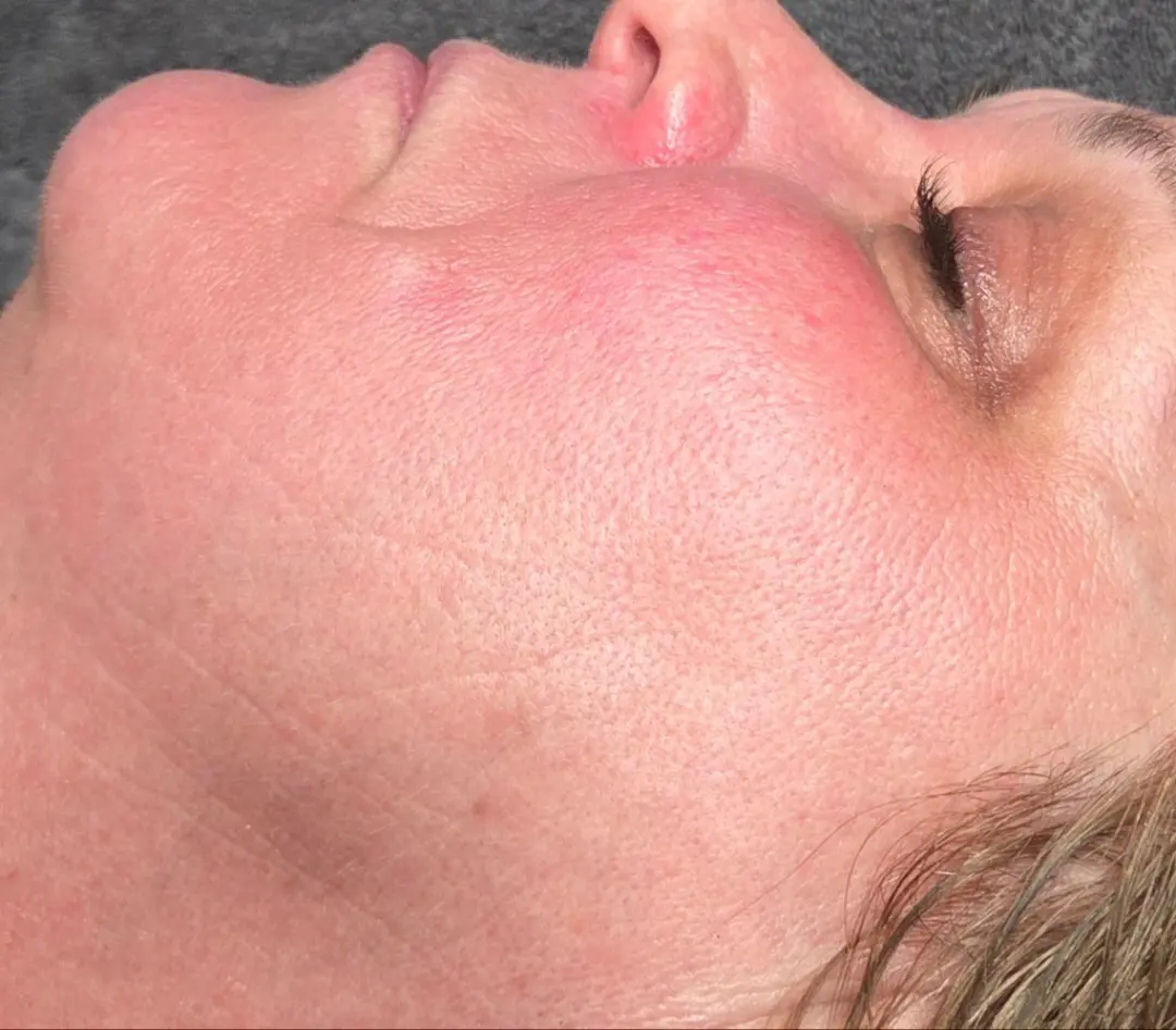 Bio Pulse behandeling bij SKIN MISSION in Eindhoven