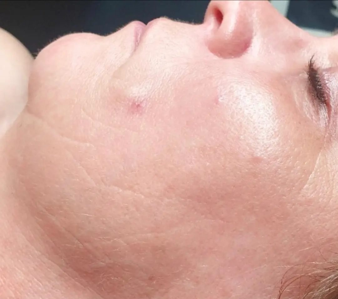 Bio Pulse behandeling bij SKIN MISSION in Eindhoven