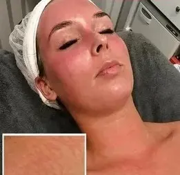 BioPulse behandeling bij SKIN MISSION in Eindhoven