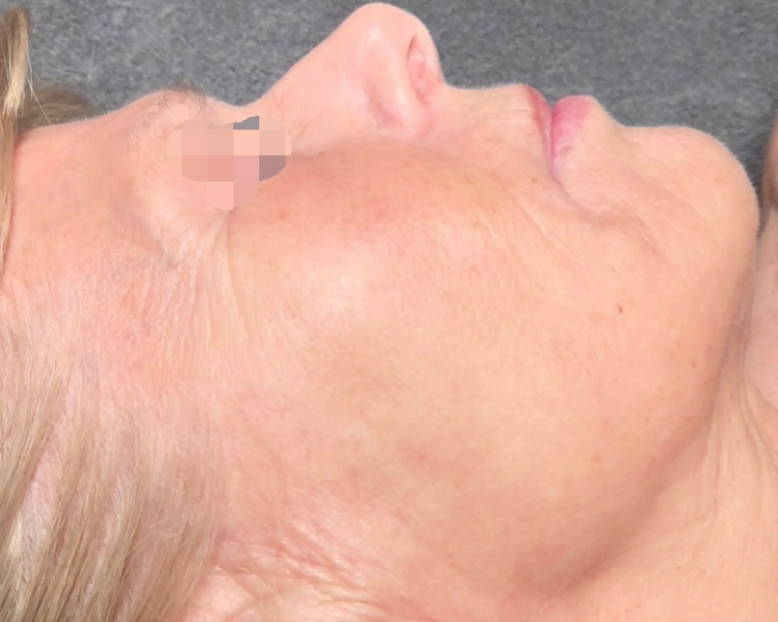 Natural face lift behandeling bij SKIN MISSION in Eindhoven