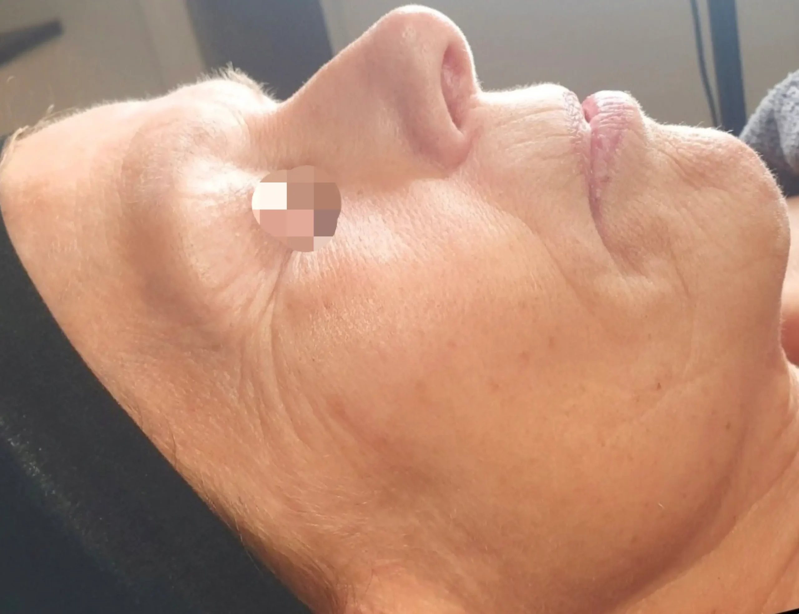 Natural face lift behandeling bij SKIN MISSION in Eindhoven